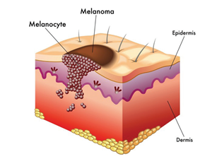 A mole is a natural formation that can be removed by using Skincell Pro
