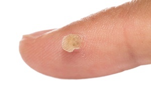 Warts is a skin disease that effectively fights Skincell Pro